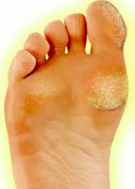 Corns and calluses are areas of thick, dry skin that develop when skin is exposed to excessive pressure or friction. Callus Perform Podiatry