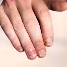 nagelpsoriasis schuppenflechte an den nageln schuppenflechte info schuppenflechte nagel schuppenflechte schuppen
