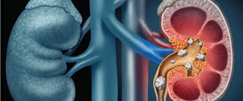 Act early to counter the agony of kidney stones - urologist - Urology  Hospital