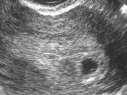 5 Ssw 5 Schwangerschaftswoche Grosse Entwicklung 9monate De