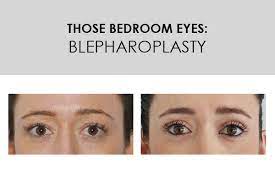 81 all signs point to the lead detective's girlfriend: Those Bedroom Eyes Blepharoplasty