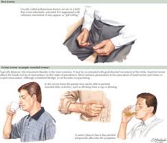 Image result for Rest Tremor