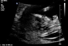 Rund Um Gebarmutter Plazenta Muttermund Februar 2015 Babyclub Seite 2 Babycenter