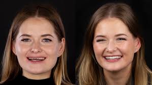 Conventional vs Guided Cementation (FirstFit®): Insights from a Joint Study  by the University of Genoa and VIAX