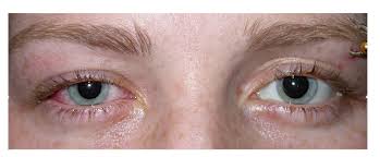 Image result for Scleritis