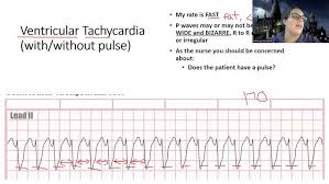Image result for Ventricular Fibrillation Management in the Adult
