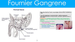 Fournier gangrene usually requires immediate surgery to remove the infected tissue. Fournier Gangrene Causes Pathophysiology Features Diagnosis And Treatment Youtube