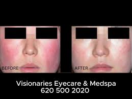 New things are happening!!!! , #DryEyes #Lumenis #LumenisAesthetics