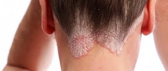 Das diferentes doenças e patologias que podem afetar a pele, a psoríase quase certamente se torna um dos mais populares, não só porque é conhecido, mas porque é um dos que mais afeta um grande número de pessoas. Psoriase Definicao Sintomas E Tratamento Saude Colegio Web