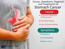 Your stomach receives and holds the food you eat and then helps to break down and digest it. Causes Symptoms Diagnosis And Treatments For Stomach Cancer