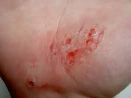 Occurs after skin rubs against hard surface often contains foreign particles. Abrasion Medical Wikipedia
