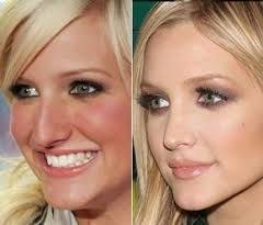 Rhinoplasty Cost The Average Cost Of Rhinoplasty Is 4 545 According To 2013 Statistics From The A Celebrity Plastic Surgery Nose Surgery Rhinoplasty Nose Job