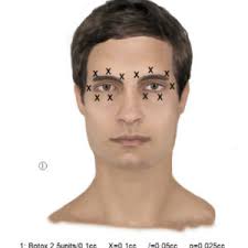 Multidisciplinary Management of Neuropathic Eye Pain and Blepharospasm