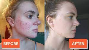 Best Acne Treatment Retinol Is The Gold Standard Here S Why Clearly Basics Topical retinoids are a class of prescription medications used to control comedonal acne (blackheads and whiteheads). best acne treatment retinol is the