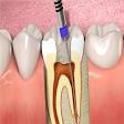 Root Canal Treatment product image