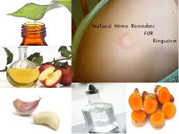 Natural Home Remedies For Ringworm Treat Skin Infections