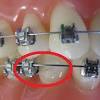 Before putting wax on the wire, brush, and floss your teeth properly to remove all the food debris. 1