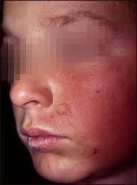 Singapore mum warns about sunscreen allergy after child suffers swollen face and rashes. Have You Ever Heard Of An Allergy To Sunscreen Contact Dermatitis Rash On Face Face Rash Remedies