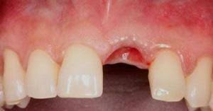Tooth extraction healing time removal process electric teeth uk. Wisdom Tooth Removal Recovery Period Natural Dentist Associates