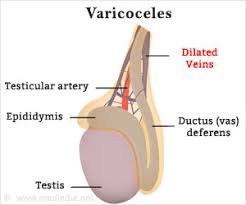 Is Varicocelectomy The Answer To Painful Varicoceles In Men