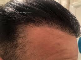 Hair transplant results hair transplant cost receding hair styles hair clinic going bald hair restoration hair loss treatment free hair hairline. What S Behind A Great Hairline Dr Bruno Ferreira Leading Edge Hair Transplant Surgery