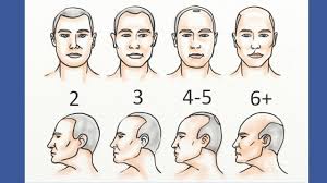 Norwood 2 Hairline 3 Ways To Stop It Naturally Before It