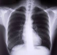 Chronisch obstruktive lungenerkrankung (copd) ist eine schwere lungenerkrankung , die ein paar verschiedene. Copd Durch A1 Antitrypsin Mangel Selbsthilfe Copd Nurnberg
