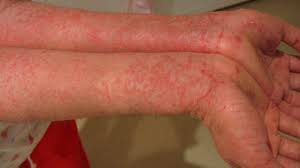 Image result for allergy rash on the legs