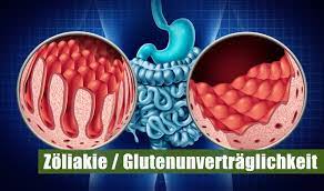 Bei konsequenter diät tritt innerhalb eines monats eine besserung der beschwerden ein. Zoliakie Und Glutenunvertraglichkeit Kochenohne