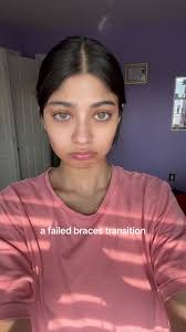 it just got worse and worse LMAO #fyp #braces #transition