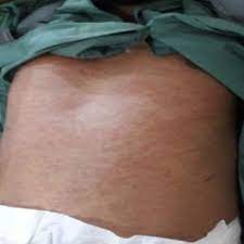 Pdf Clindamycin Induced Cutaneous Drug Reaction A Case Report