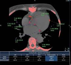 Ct Calcium Scoring For Heart Disease May Lead To Prevention