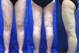 Image result for Lipodystrophy