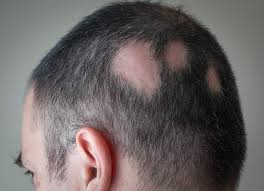 When the hair loss occurs in patches, this is termed alopecia areata. Losing Hair In Strange Places It Could Be Alopecia Areata