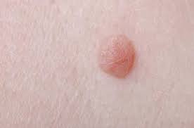 Como Quitar Verrugas En El Cuello