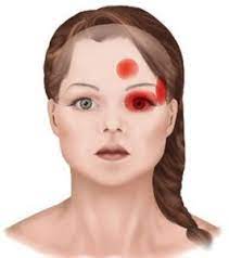 Headache Above Left Eye Symptoms Causes And Treatments