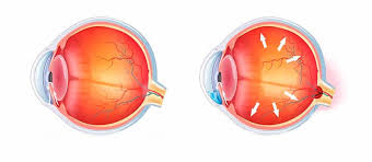 Image result for Glaucoma