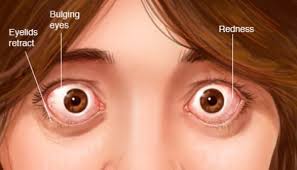 eye disiese