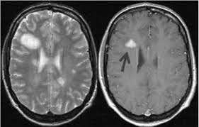 Su diagnóstico depende de la experiencia clínica y del empleo de. Diagnostico Precoz De La Esclerosis Multiple Uab Barcelona