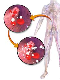 Hyperglycemia Wikipedia