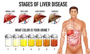 Image result for acholic stools human