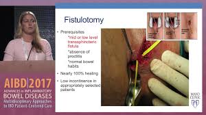 It can also result in a recurring abscess, if the outer opening heals first, blocking drainage from the healing gland. Ibd Surgery Perianal Abscess And Fistula Youtube