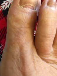 Image result for Pitting nails feet