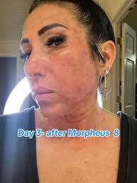 Morpheus 8 Recovery Day 3