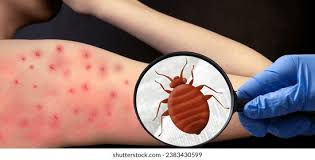 Image result for Cimex lectularius bites