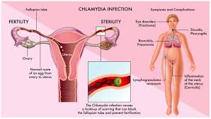 Image result for chlamydia symptoms