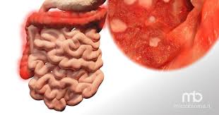 Cure più efficaci e «su misura». Colite Ulcerosa E Trapianto Di Microbiota Anaerobico Quali Vantaggi