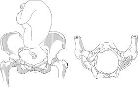 Image result for Brow Presentation