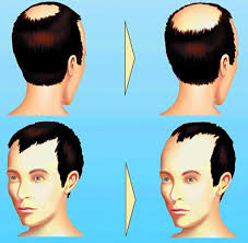 Wir helfen dir mit wertvollen tipps und informieren dich über die formen und ursachen von alopezie. Haarausfall Wie Der Kopf Gar Nicht Erst Kahl Wird Welt