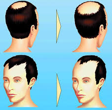 Der runde, lokal begrenzte krankhafte haarausfall ist die häufigste entzündliche haarausfallerkrankung und tritt in jedem alter auf. Haarausfall Wie Der Kopf Gar Nicht Erst Kahl Wird Welt